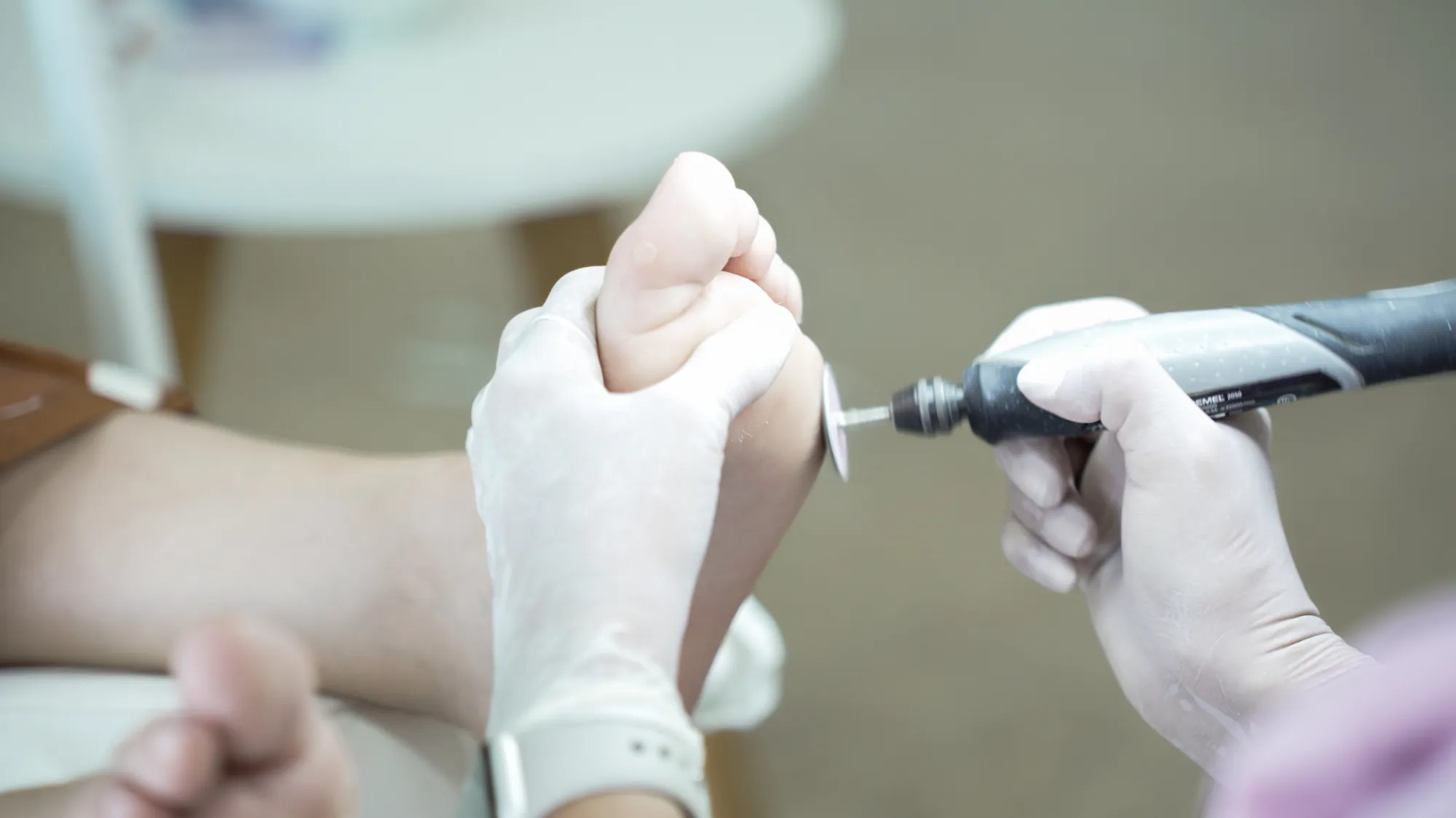 Detalle de tratamiento podológico con fresadora